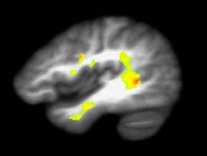 Marijuana Addiction Brain Marijuana Addiction Brain