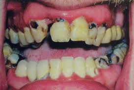 What Drug Abuse Does to Your Teeth?