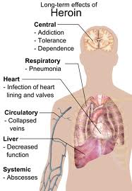 Long-term effects of Heroin