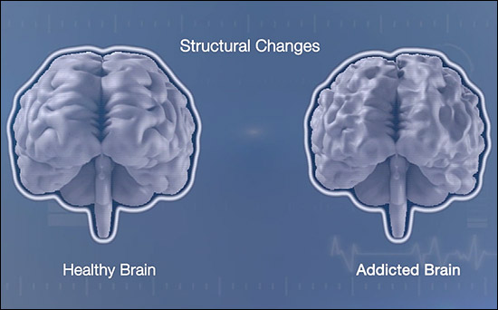 Structural Brain Changes Front