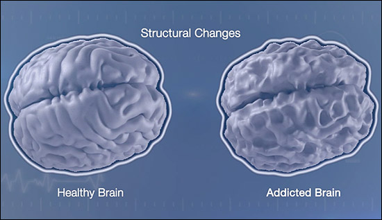 Structural Brain Changes Top
