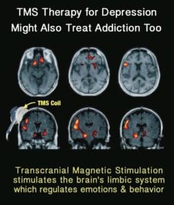 TMS Therapy for Depression and Addiction