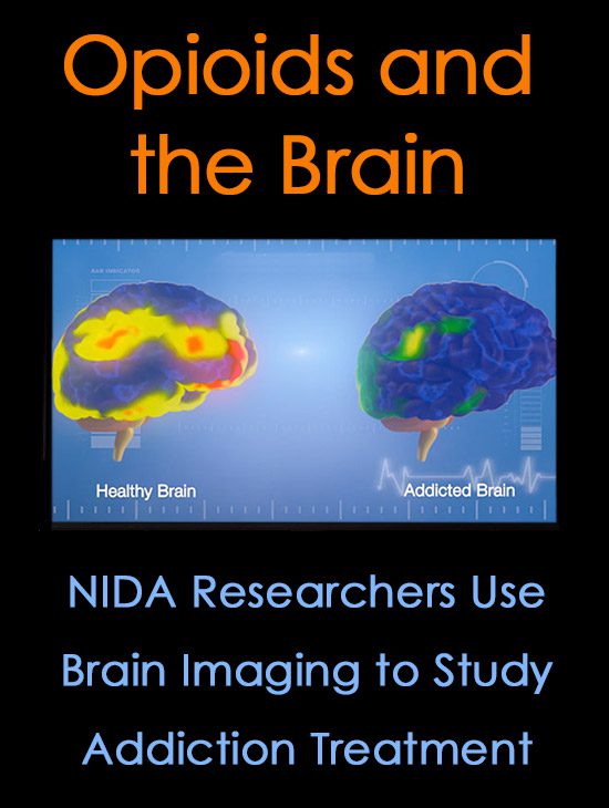 Opioids and the Brain: NIDA Researchers Use Brain Imaging to Study Addiction Treatment